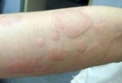 荨麻疹吃梨瓜,梨瓜助力缓解症状