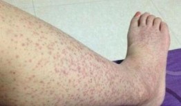 吃哈密瓜治疗过敏性紫癜,天然良方助治过敏性紫癜