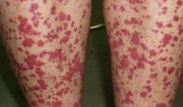 吃哈密瓜治疗过敏性紫癜,天然良方助治过敏性紫癜